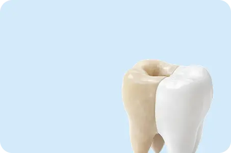 Лечение кариеса