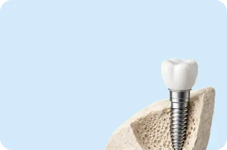 Имплантация зубов