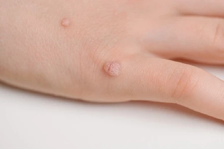 Удаление бородавок и папиллом