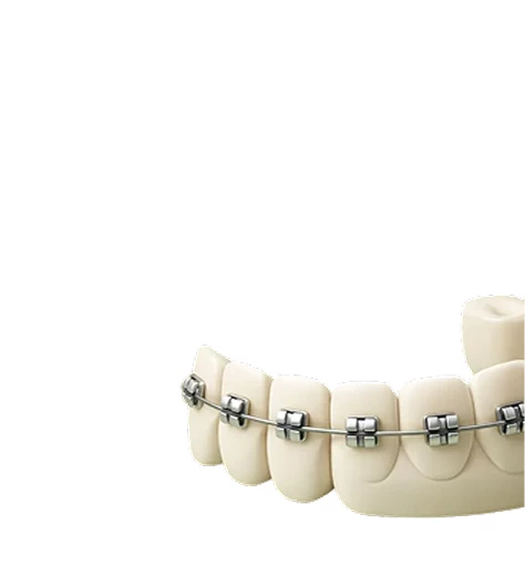 Исправление прикуса