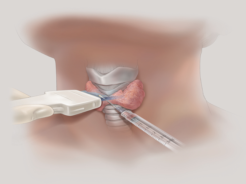 Тонкоигольная биопсия щитовидной железы