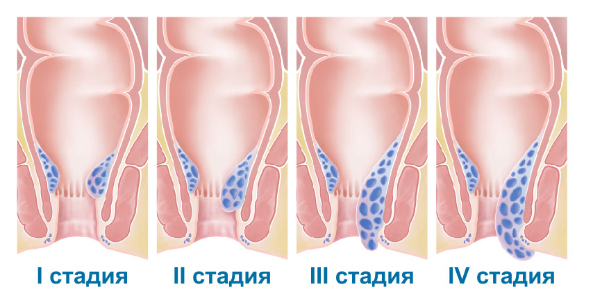 Лечение тромбоза геморроидального узла