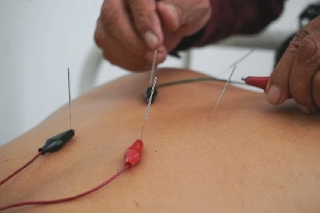 Внутритканевая электростимуляция Герасимова