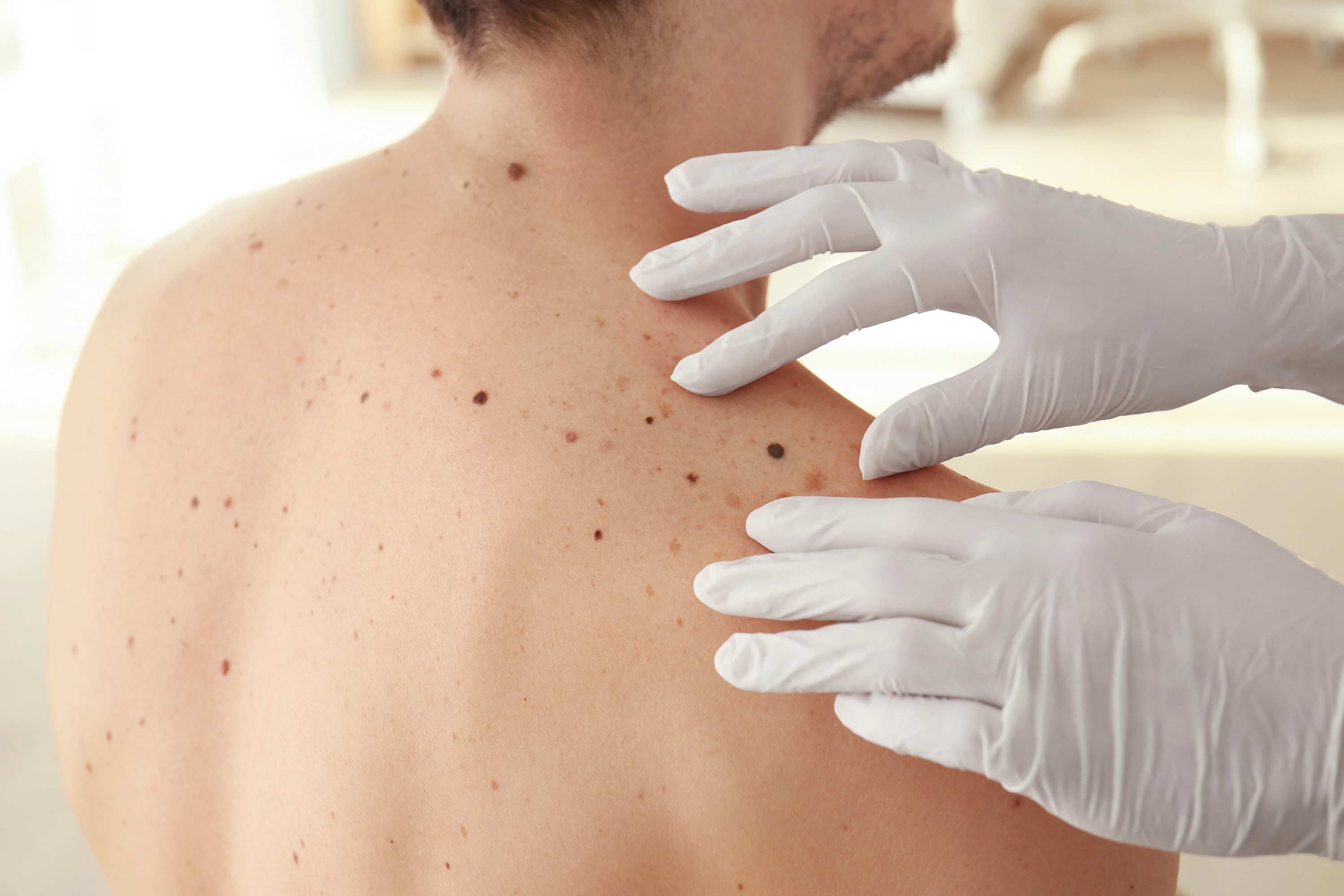 Причины запущенности поверхностно-распространяющейся меланомы кожи.