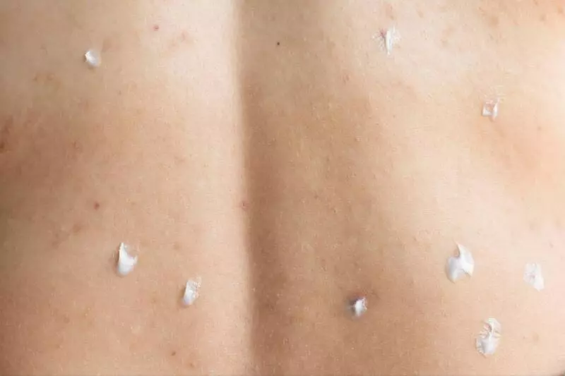 Терапия контагиозного моллюска