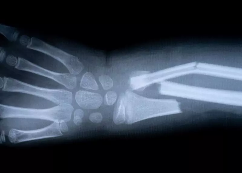 Диагностика переломов