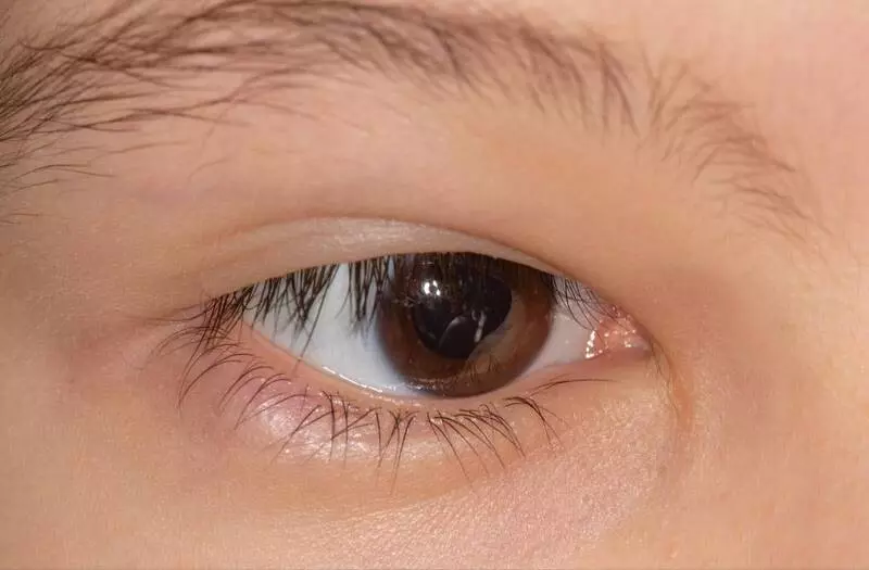 Насколько выраженной может быть эпикантальная складка