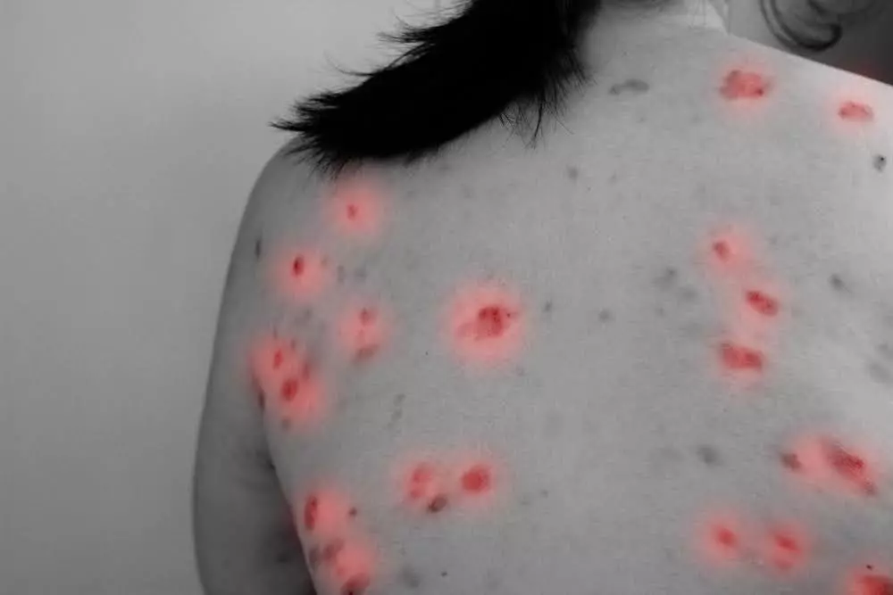 Чем розовый лишай отличается от других кожных заболеваний