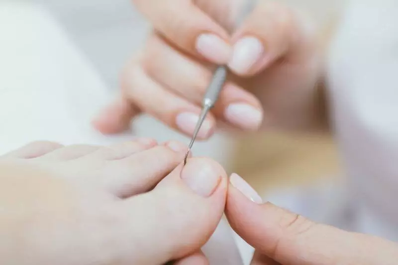 Удаление вросшего ногтя