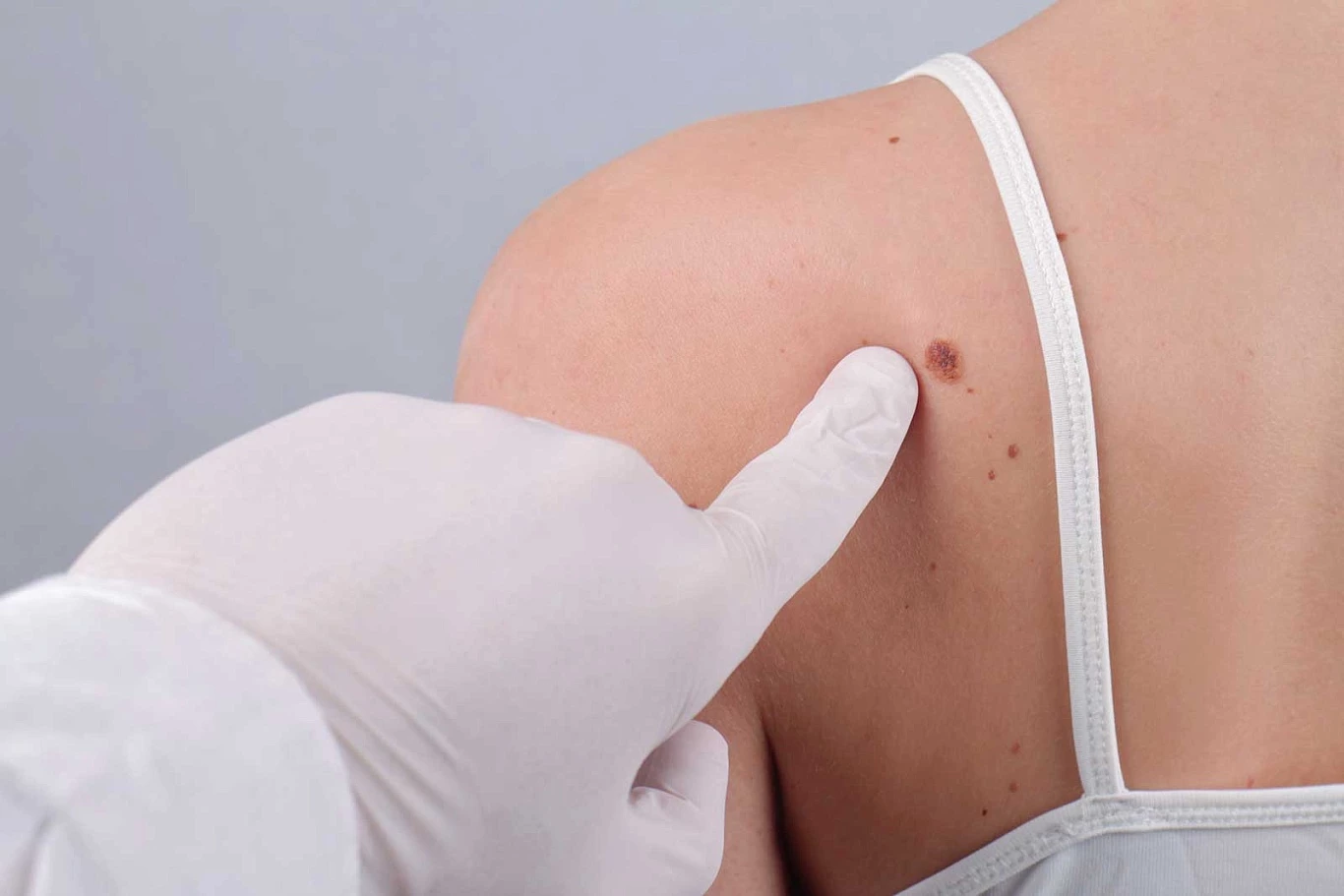 Результаты эксцизии пигментных образований у больных с клиническим диагнозом прогрессирующий диспластический невус.