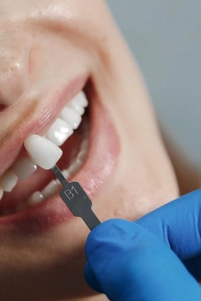 Имплантация передних зубов