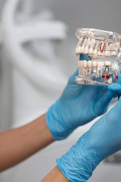 Импланты Nobel