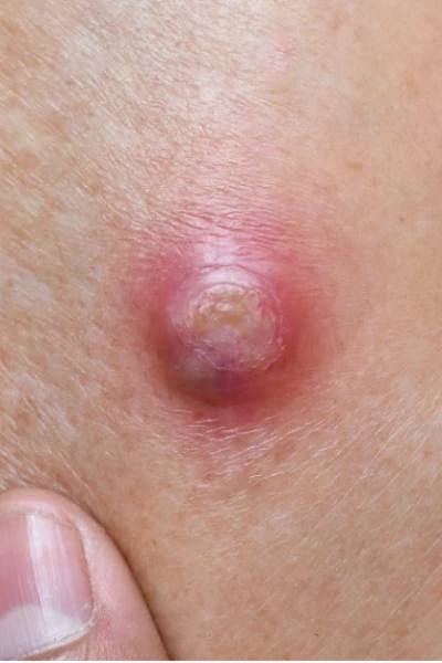 Вскрытие и дренирование абсцесса