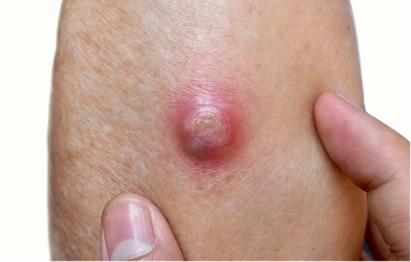 Вскрытие и дренирование абсцесса