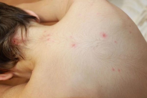 Фурункулез