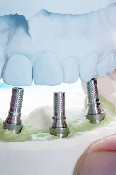 Имплант нижней челюсти