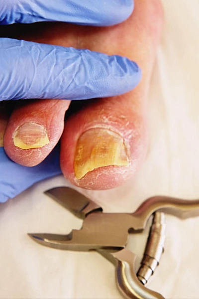 Удаление ногтевой пластины