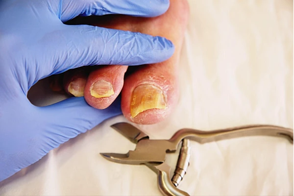 Удаление ногтевой пластины