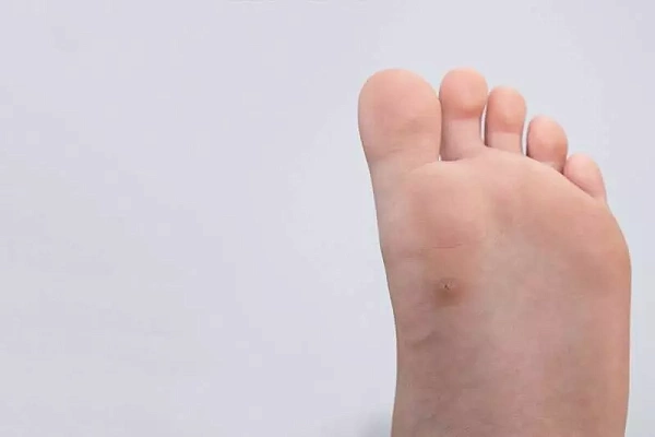 Удаление бородавок