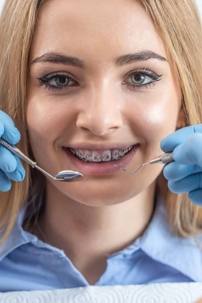 Установка брекетов