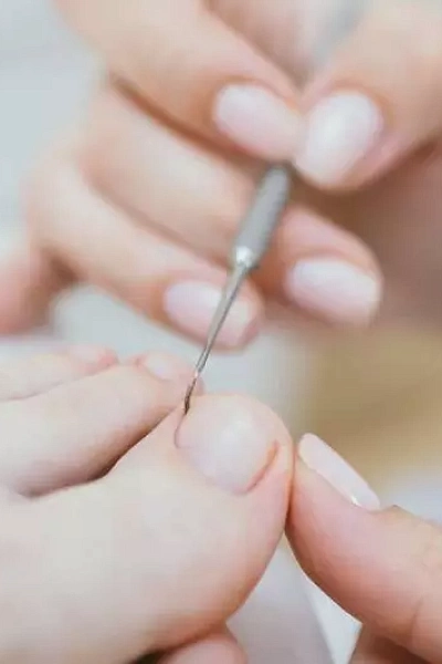 Удаление вросшего ногтя